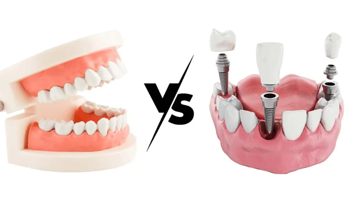Dental Implants vs. Dentures: Which is Right for You?