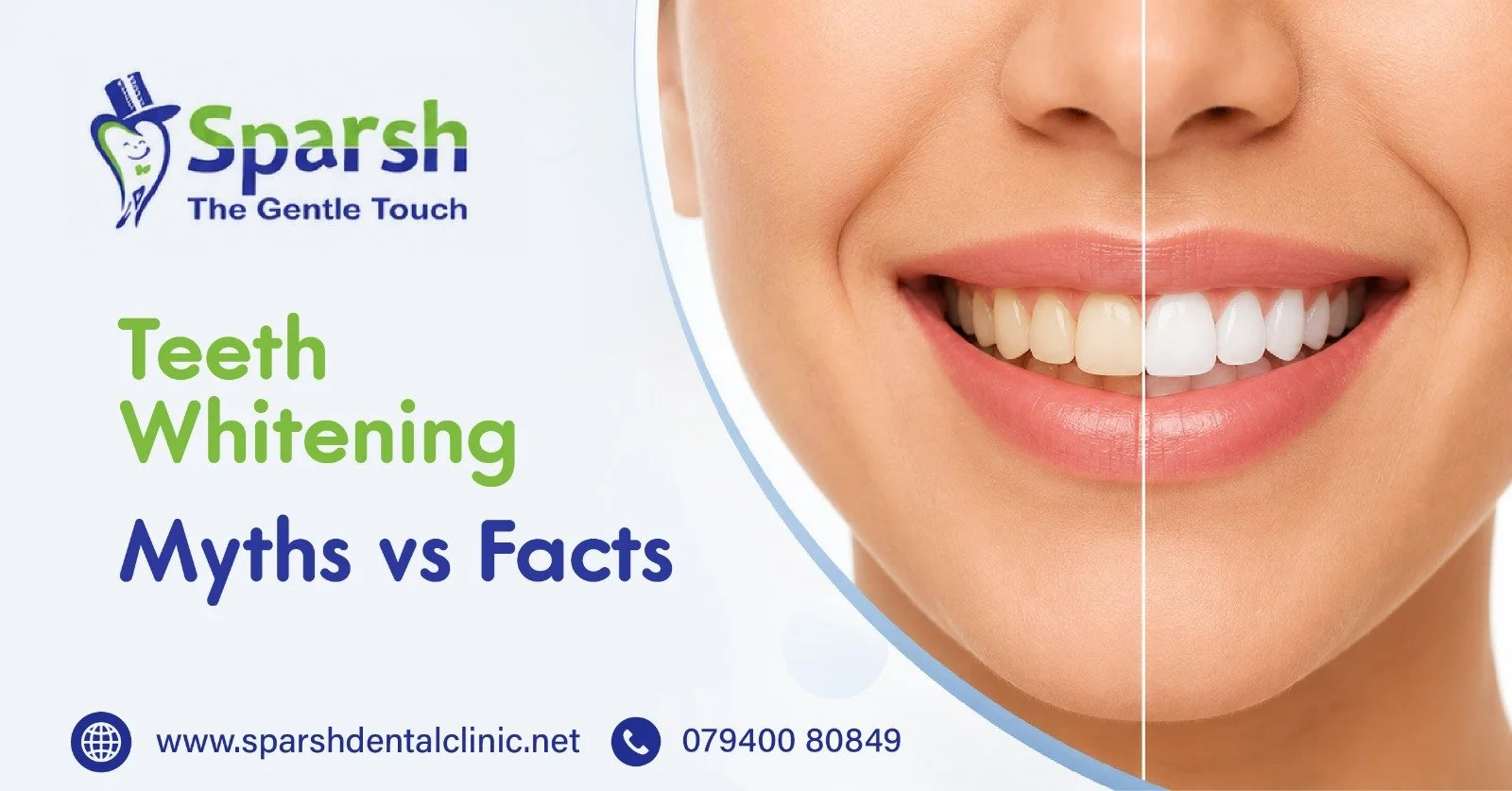 Teeth Whitening: Myths vs Facts